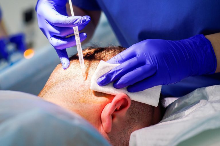 Hizli-Sac-Ekimi-Kimler-icin-Uygundur